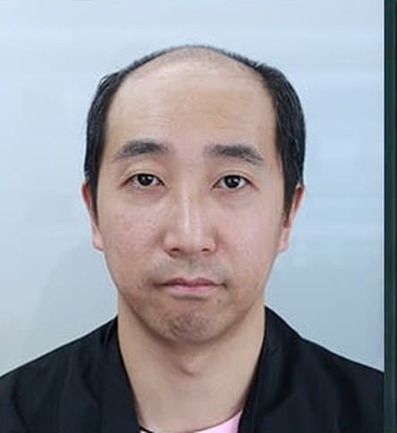 復原法客人佩戴前,正面